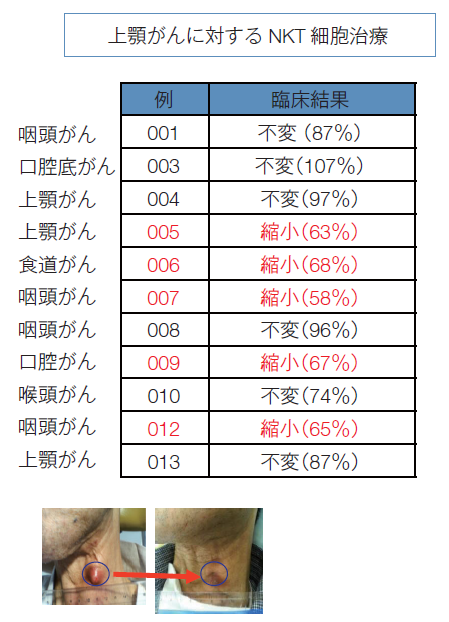 がん細胞と免疫細胞のイメージ
