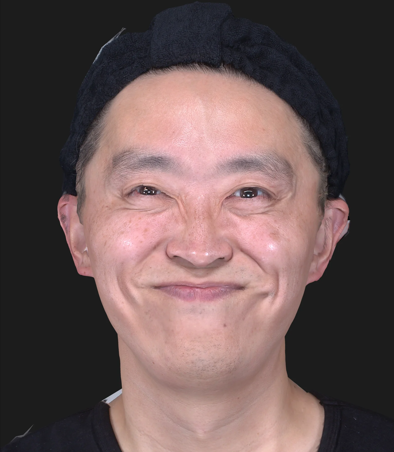 ボトックス注射(目尻) 施術後