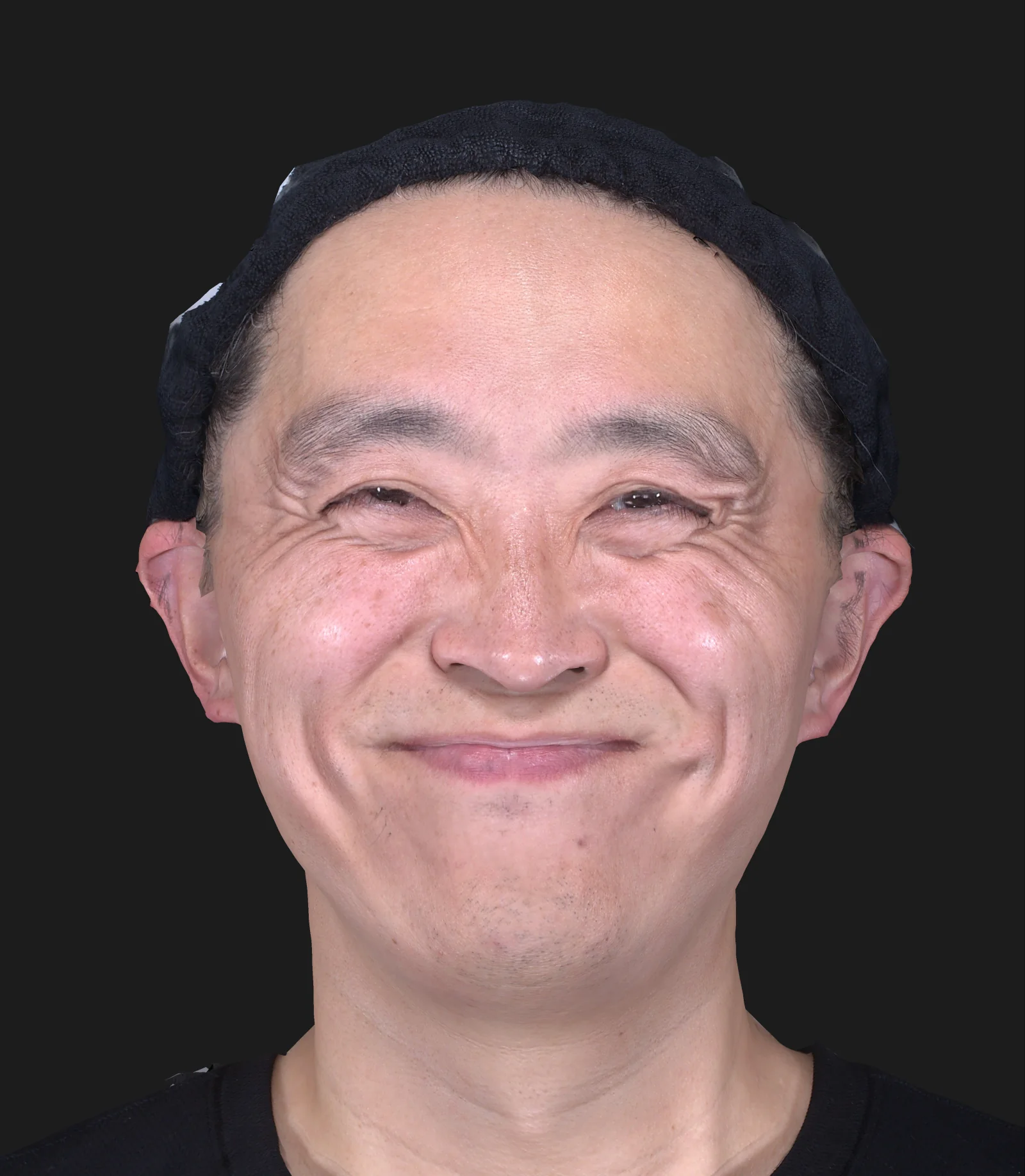 ボトックス注射(目尻) 施術前