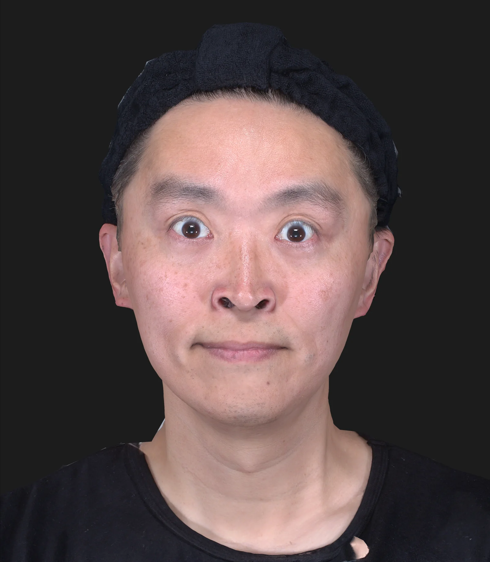 ボトックス注射(額) 施術後