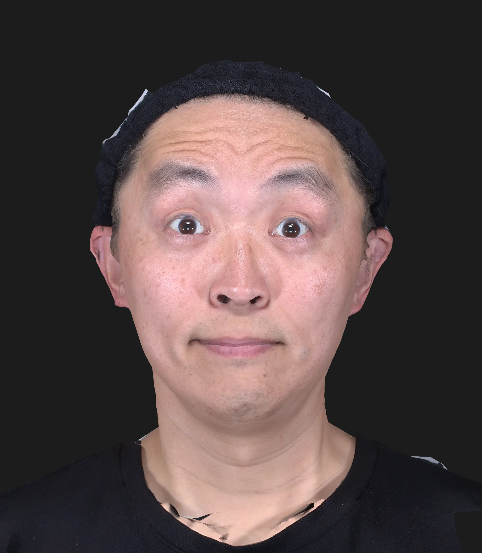ボトックス注射(額) 施術前