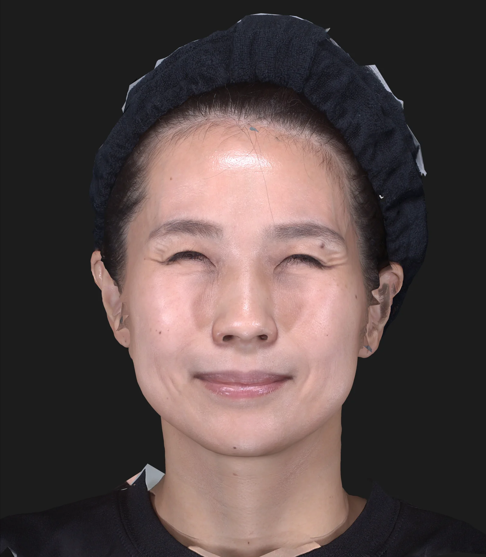 ボトックス注射(眉間) 施術後
